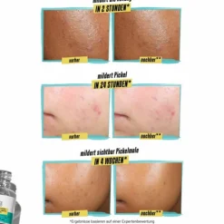 KIEHL'S Spezialpflege·Akne|